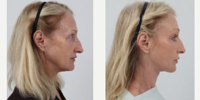 65-74 year old woman treated with Facelift, Neck Lift, Brow Lift, Eyelid Surgery, Facial Fat Transfer, Chemical Peel - 66 year old 2.5 months post Facelift, Neck lift, Brow Lift, Lower Bleph, Fat transfer and TCA peel