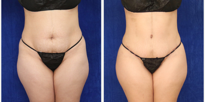 Woman treated with Tummy Tuck - Woman treated with Tummy Tuck