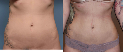18-24 year old woman treated with Rib Removal and Liposuction - Waistline narrowing by a combination of rib removals and flank liposuction.