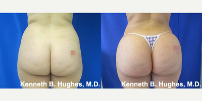 Brazilian Butt Lift - This patient underwent liposuction of the abdomen, sides, and back with fat transfer to the buttocks.
