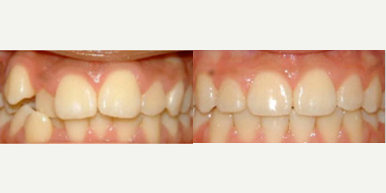 35-44 year old man treated with Damon Braces - Damon Braces Treatment