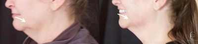 Woman treated with Cryoskin - Woman treated with Cryoskin