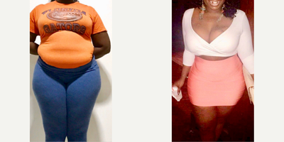 35-44 year old woman treated with BodyTite, Liposuction - 35-44 year old woman treated with BodyTite, Liposuction