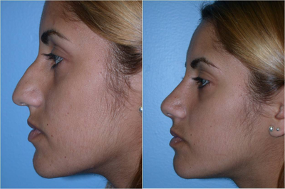 Nose surgery (Rhinoplasty) - 24 year old patient with a droopy nose with a bump. Procedure: Nose surgery (rhinoplasty)