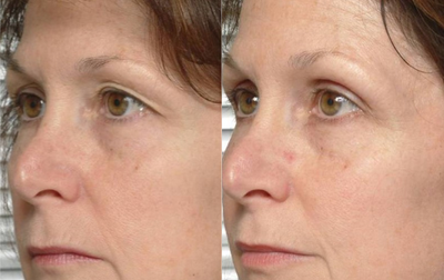 45-54 year old woman treated with Thermage - 1 month after Thermage eyes