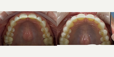 55-64 year old woman treated with Da Vinci Veneers, Porcelain Veneers - Female patient wanted to change her smile a while ago, she was hesitant to make the decision, but after a comprehensive dental evaluation and a digital smile design visit, we were able to listen to her concerns and her expectations, we built a couple of proposals and she decided to start the process of her new smile. She wanted to replace old composite restorations that were stained and chipped, and she also had loss of enamel due to wear. We restore her smile with minimally-invasive veneers, and hand crafted veneers (Da Vinci Veneers) by our ceramist. She absolutely loved the results and she is very happy and confident to smile again!.