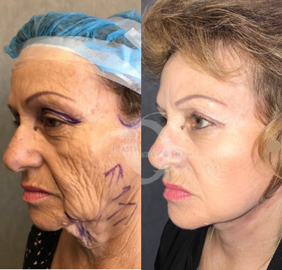 Woman treated with Laser Treatment - Woman treated with Laser Treatment, shown 2 weeks post op. Patient also had deep chemical skin treatment (chemical peel) as well as Mehr design full facelift, extended neck lift, and upper eyelid surgery.