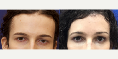 Patient treated with Chemical Peel - Patient treated with Chemical Peel