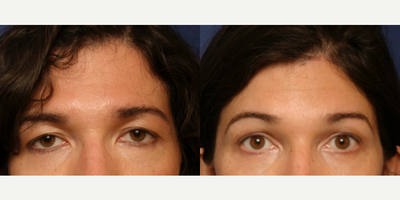 Patient treated with Chemical Peel - Patient treated with Chemical Peel
