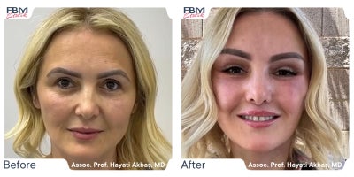 25-34 year old woman treated with Deep Plane Facelift, Facial Fat Transfer, Eyelid Surgery - 25-34 year old woman treated with Deep Plane Facelift, Facial Fat Transfer, Eyelid Surgery