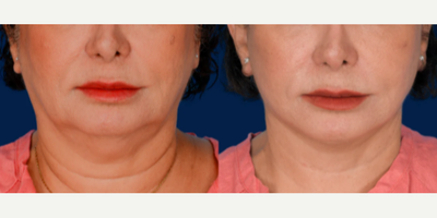 Woman treated with Chin Liposuction - Woman treated with SMAS Facelift, Neck Lift, and Chin Liposuction