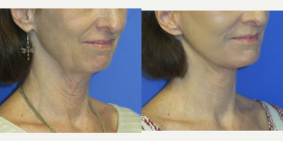 63 year old woman treated with Lifestyle Lift - 63 year old female seeking rejuvenation of her lower face and specifically her jowls, jawline, and neck. She also had her lower eyes and mouth treated with CO2. She had a lower facelift with neck lift under local anesthesia.
