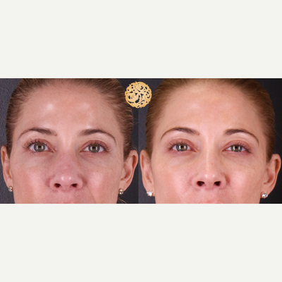 35-44 year old woman treated with Vivace - Vivace creates clearer skin with improved texture and reduced scarring.