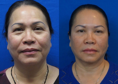 55-64 year old woman treated with Thermage - No other treatments.  Procedure performed by Dr. Khorsandi.  Average treatment level 3.5
