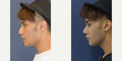18-24 year old man treated with Rhinoplasty - 18-24 year old man treated with Rhinoplasty