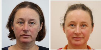 45-54 year old woman treated with TCA Peel, Eyelid Surgery - Blepharoplasty / TCA Chemical Peel
