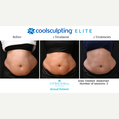 45-54 year old woman treated with CoolSculpting Elite - CoolSculpting Elite on the abdomen!