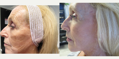 55-64 year old woman treated with Laser Resurfacing - This patient came in with concerns of aged skin, sun damage, age spots, wrinkles and thin skin. We recommended 3 treatments with our Lux 1540 from Cynosure. Patient had 3 treatments four weeks apart and stayed on top of her appointments we were able to give her a treatment in May, June and then final treatment was done in July. She is very happy with the results she got a few months before her wedding! (Notice the dark spot on her cheek is only noticeable to those who are looking for it!)