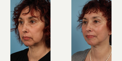 Woman treated with Lower Facelift - Woman treated with Lower Facelift