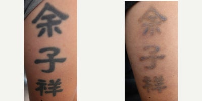 25-34 year old man treated with Tattoo Removal - Laser tattoo removal after 13 sessions. Following the procedures, the patient experienced remarkable improvements in their tattoo fading. Laser Tattoo Removal is performed with a Spectra Q Switch Laser.