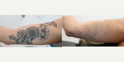 35-44 year old woman treated with Laser Tattoo Removal - Laser tattoo removal of an arm tattoo after 8 sessions. Following the procedures, the patient experienced remarkable improvements in their tattoo fading. Laser Tattoo Removal is performed with a Spectra Q Switch Laser.