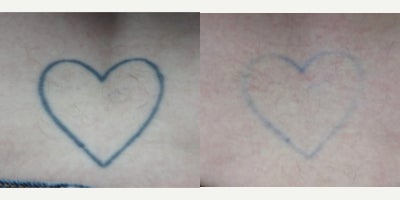 35-44 year old woman treated with Tattoo Removal - Laser tattoo removal at the 11th session. Following the procedures, the patient experienced remarkable improvements in their tattoo fading. Laser Tattoo Removal is performed with a Spectra Q Switch Laser.