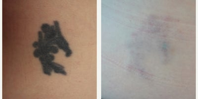 45-54 year old man treated with Tattoo Removal - Laser tattoo removal after 13 sessions. Following the procedures, the patient experienced remarkable improvements in their tattoo fading. Laser Tattoo Removal is performed with a Spectra Q Switch Laser.