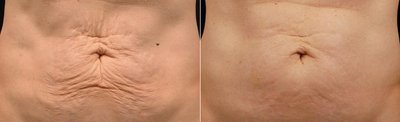 Treated with Thermage - Treated with Thermage