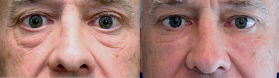 ArteFill: Now Called Bellafill  - Artefill (now called Bellafill)&nbsp;is an excellent alternative to surgery in patients like this 60 year old man who wanted to look natural, did not want surgery, and did not want to have to keep coming back for more injections like he would have with other fillers. Seen here at 14 months after the Bellafill treatment, the result will last at least 5 years and likely much longer. It feels and looks natural.&nbsp;