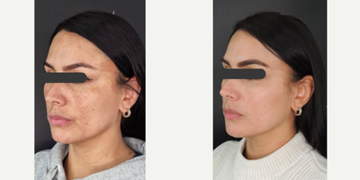 Woman treated with Chemical Peel - Woman treated with Chemical Peel