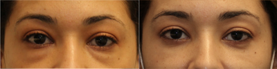 lower blepharoplasty for eye bags - Eye bags removed/repositioned from behind the eyelid (scarless, transconjunctival technique)