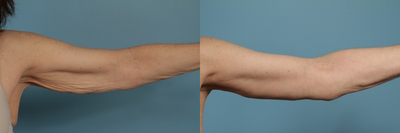 Patient treated with Arm Lift - Patient treated with Arm Lift