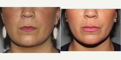 25-34 year old woman treated with Lip Augmentation - Young woman desiring natural augmentation of her lips. Augmentation done with local anesthetic block. Hyaluronic acid filler.