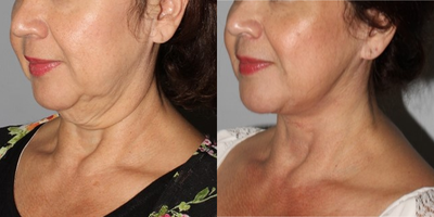 55 year old female treated with MACS face lift and full neck lift after massive weight loss. - Patient primarily desired improvement in her neck contour with more definition to her jawline which was achieved giving her a beautiful and natural result.