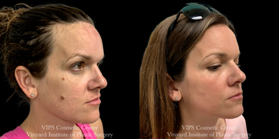 35-44 year old woman treated with CoolPeel, CO2 Laser - 35-44 year old patient treated with CO2 laser skin resurfacing CoolPeel to reduce fine lines, wrinkles, sun damage, pore size and improve overall skin brightness, texture and tone.