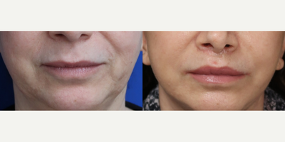Woman treated with Lip Lift - Our lip lift treatments at Faceology are designed to give you a more defined, fuller smile.