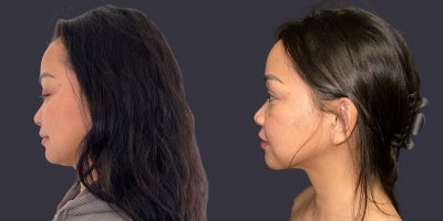 25-34 year old woman treated with Chin Liposuction, Liposuction - 34 year old woman, 5 tall, 112 pounds, no children yet. Submental liposuction to reduce double chin and define jawline.