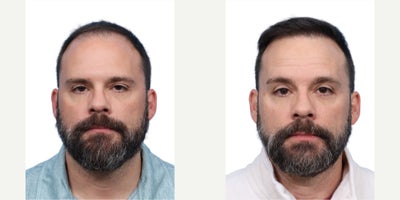 43 year old man treated with FUE Hair Transplant, PRP for Hair Loss - Goals: To restore density on the hairlineProcedure: FUE hair transplant and PRP Hair TherapyGrafts: 4050 grafts, zones 1,2 and 4Photo Timeline: 1 year post-op