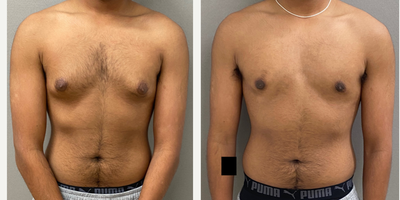 18 year old man treated with Gynecomastia Surgery - 18 yo s/o male breast reduction performed under local anesthesia with sedation in our on site AAAA certified operating suite