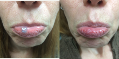 35-44 year old woman treated with Excel V - Excel V treatment for vascular lesion (venous lake) on lower lip immediately after one treatment.