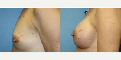 45-54 year old woman treated with Breast Implants - Height : 5'6 
WT : 129 
Age : 47 
Implant make : Allergan Natrelle 
style : 371 cc gel mid profile 
placement : sf (subfascial)