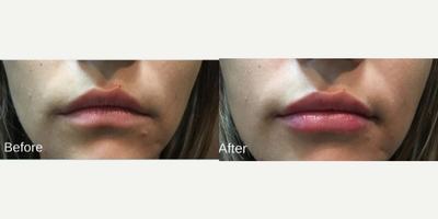25-34 year old woman treated with Juvederm - Patient had 1cc syringe of Juvederm Ultra to get beautiful and natural results.