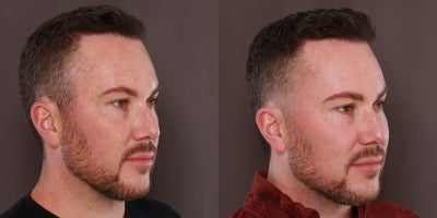 25-34 year old man treated with Moxi, Microneedling - 1 Moxi and 1 Sylfirm X Treatment