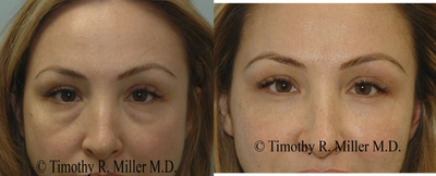 Lower eyelid rejuvenation - The patient was concerned about her tired, sad appearing eyes.  A lower blepaharoplasty using the fat repostioning technique with fat augmentation was used to provide her with a refreshed appearance.  Procedures designed and performed by Timothy R. Miller, M.D.