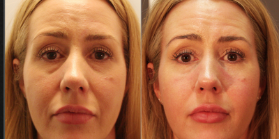 35-44 year old woman treated with Volbella to Rejuvenate Eye - 