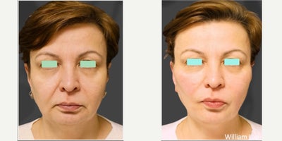 Woman treated with Thread Lift - Woman treated with Thread Lift