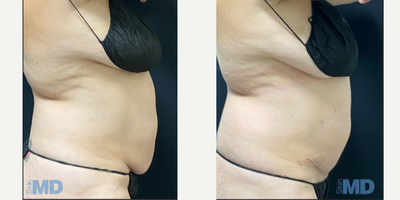 45-54 year old woman treated with Tummy Tuck - Combo treatment of Tummy Tuck with BodyTite layered for maximum results!