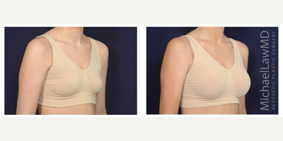25-34 year old woman treated with Mentor Breast Implants - Breast augmentation. Follow-up photo taken 3 months after the procedure.