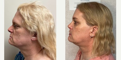 45-54 year old woman treated with Forehead Reduction, Brow Lift, Septoplasty, Rhinoplasty, Lip Lift, Lip Surgery, Adam's Apple R - This is a lady who underwent forehead feminization, septorhinoplasty, lip lift with augmentation, and chin feminization.
