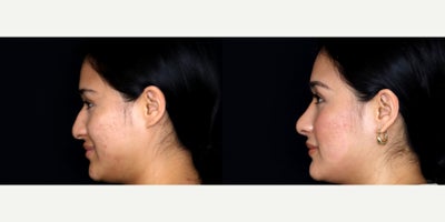 25 year old woman treated with Septoplasty, Rhinoplasty, Dermabrasion - 25 year old woman treated with Septoplasty, Rhinoplasty, Dermabrasion. Photos depict before and 2 months after surgery